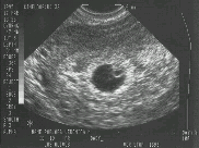 [small ultrasound image]
