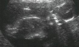 [another small ultrasound image: the hideous truth revealed!]